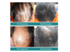 The Latest & Best Hair Loss Treatments for Men & Women in 2021