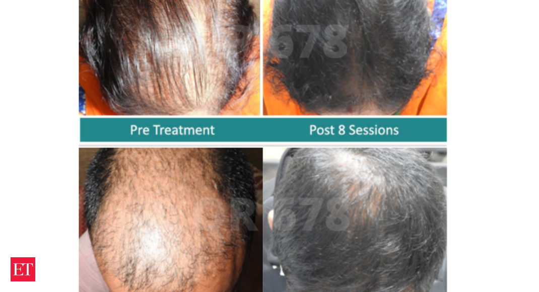 Best & Latest Hair Loss Treatment for Men and Women in India 2021
