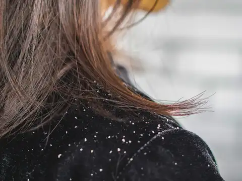 Excessive Dandruff