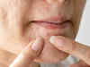 Adult acne can hamper emotional & mental well-being. Keep stress at bay, avoid milk & sugary foods