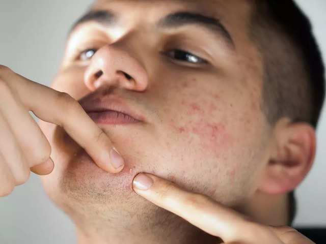 Myth: Pinching Acne Will Give Immediate Relief