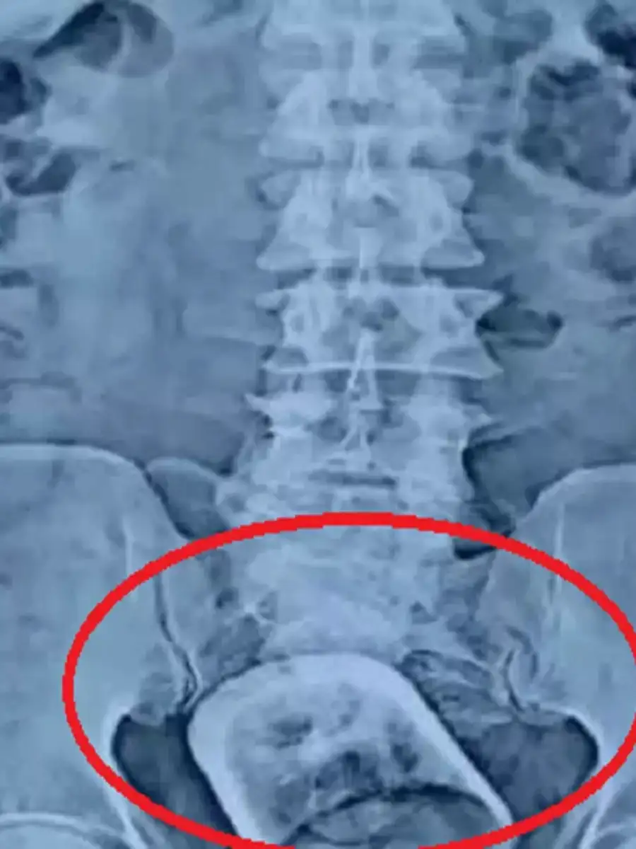 bihar stomach surgery unnao stomach surgery knife blade mobile in