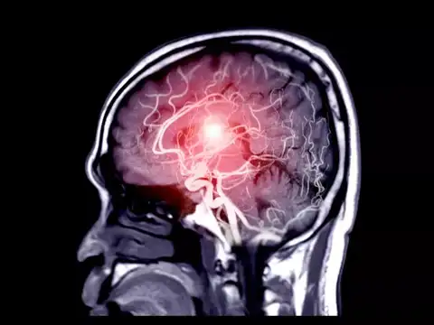 Hemorrhagic stroke