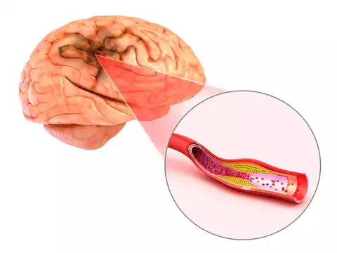 Transient Ischemic Attack