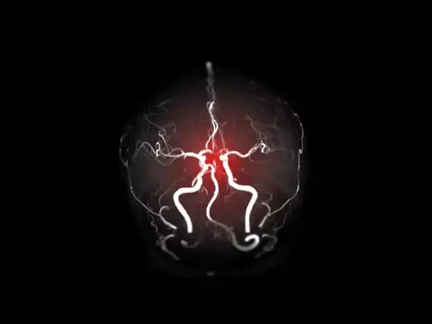Ischemic stroke
