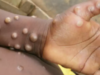 UK reports 1st case of monkeypox; symptoms include fever, rash, lymph node swelling. This is how it spreads