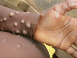 The UK has confirmed one case of Monkeypox