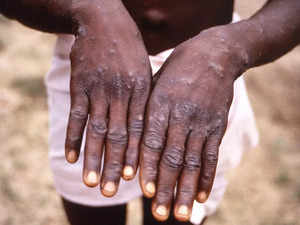 Monkeypox: Cases confirmed in 12 countries, may spread globally, says WHO