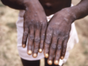 Monkeypox: UK brings in isolation measures to contain spread