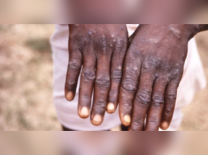 Monkeypox has not previously triggered widespread outbreaks beyond Africa, where it is endemic in animals.