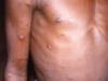 Monkeypox rash can be confused with chicken pox lesions, they can also leave scars. Learn more