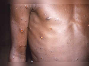 What is monkeypox? Symptoms of new virus, treatment and vaccines; here are all the details