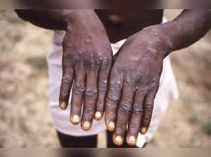 Monkeypox