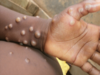Monkeypox: WHO outlines five preventive measures to stop human-to-human transmission