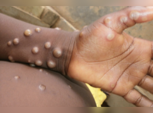 A zoonosis disease, which is transmitted from animals to humans, monkeypox is an orthopoxvirus that causes a disease with symptoms similar, but less severe, to smallpox.