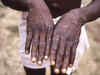 More than 1,000 monkeypox cases reported to WHO