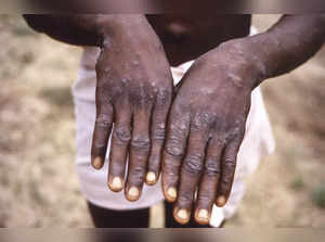 WHO eyes decision on monkeypox 'emergency', Africa says it's long overdue