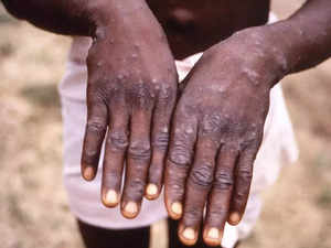 WHO reports two new monkeypox deaths, cases in new areas