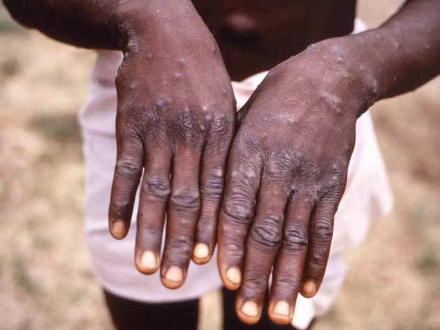 India Monkeypox News LIVE Updates: Centre asks for screening of international travellers after second confirmed case of monkeypox