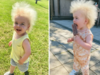 Meet the toddler who looks like Einstein because of a rare condition