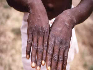 Monkeypox is a viral zoonosis - that gets transmitted to humans from animals - with symptoms similar to those seen in smallpox patients, albeit clinically less severe.