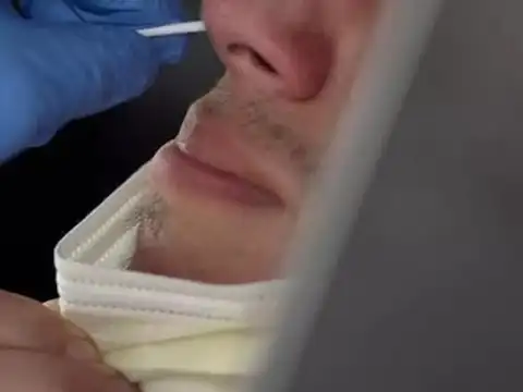 Anosmia