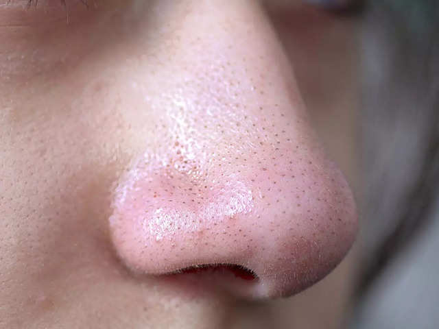 ​Melting blackheads