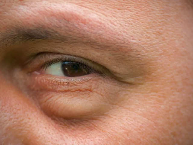 Eye Bags Treatment  Dr Davin Lim