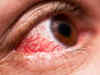How omicron infection can be detected through the eyes