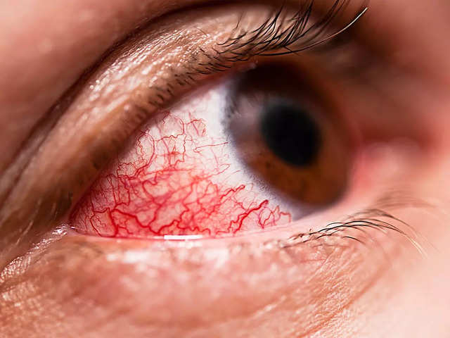 ​Is conjunctivitis a symptom of COVID