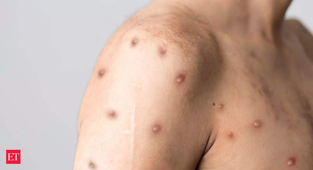 chickenpox-vaccine-uk-moves-toward-embracing-vaccine-in-policy