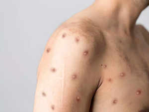 Chickenpox vaccination nearly eradicates illness's mortality, says CDC report