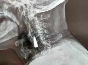 X-Ray finds bullet in military veteran Zhao He's neck 77 years after World War II