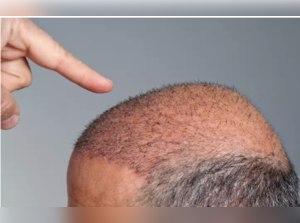 hair transplant: Man loses life after botched hair transplant treatment -  The Economic Times