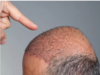 Man loses life after botched hair transplant treatment