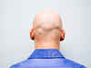 In a bold move, a bald Brit sues firm for sacking him due to baldness, gains Rs 70 lakh in damages!