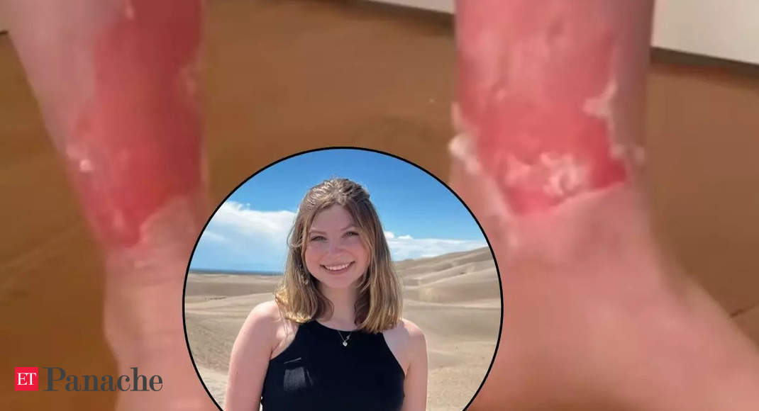 This woman has a disorder that causes her skin to peel off
