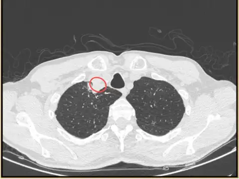 X-ray normal, but...