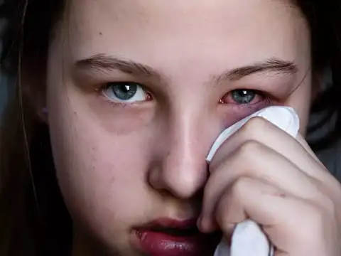 Symptoms of Arcturus