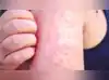 Image for Measles cases in US reach