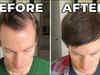 Want to grow hair again after experiencing baldness? Tech millionaire offers solution to men:Image