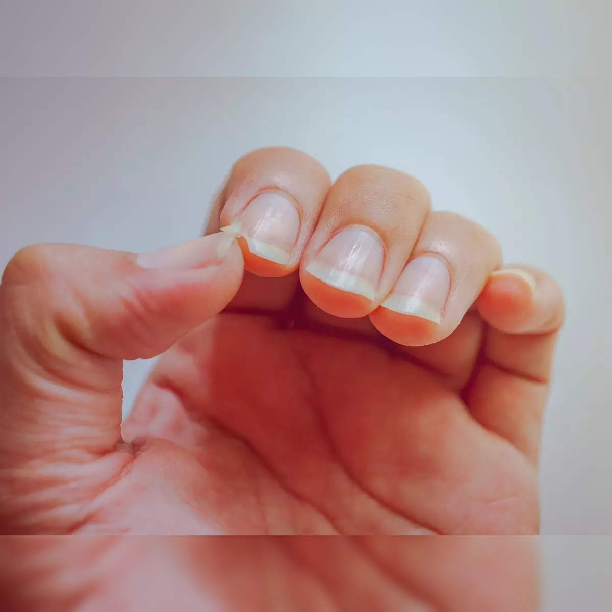 This Fingernail Mark Could Be a Skin Cancer Symptom | The Healthy @Reader's  Digest