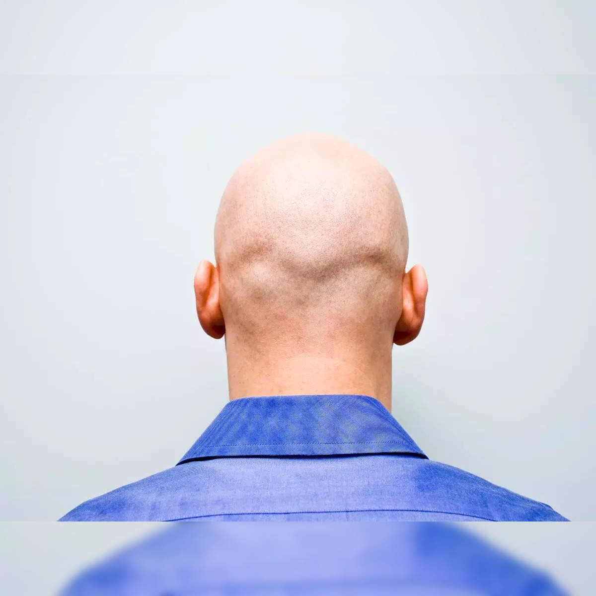 baldness: In a bold move, a bald Brit sues firm for sacking him due to