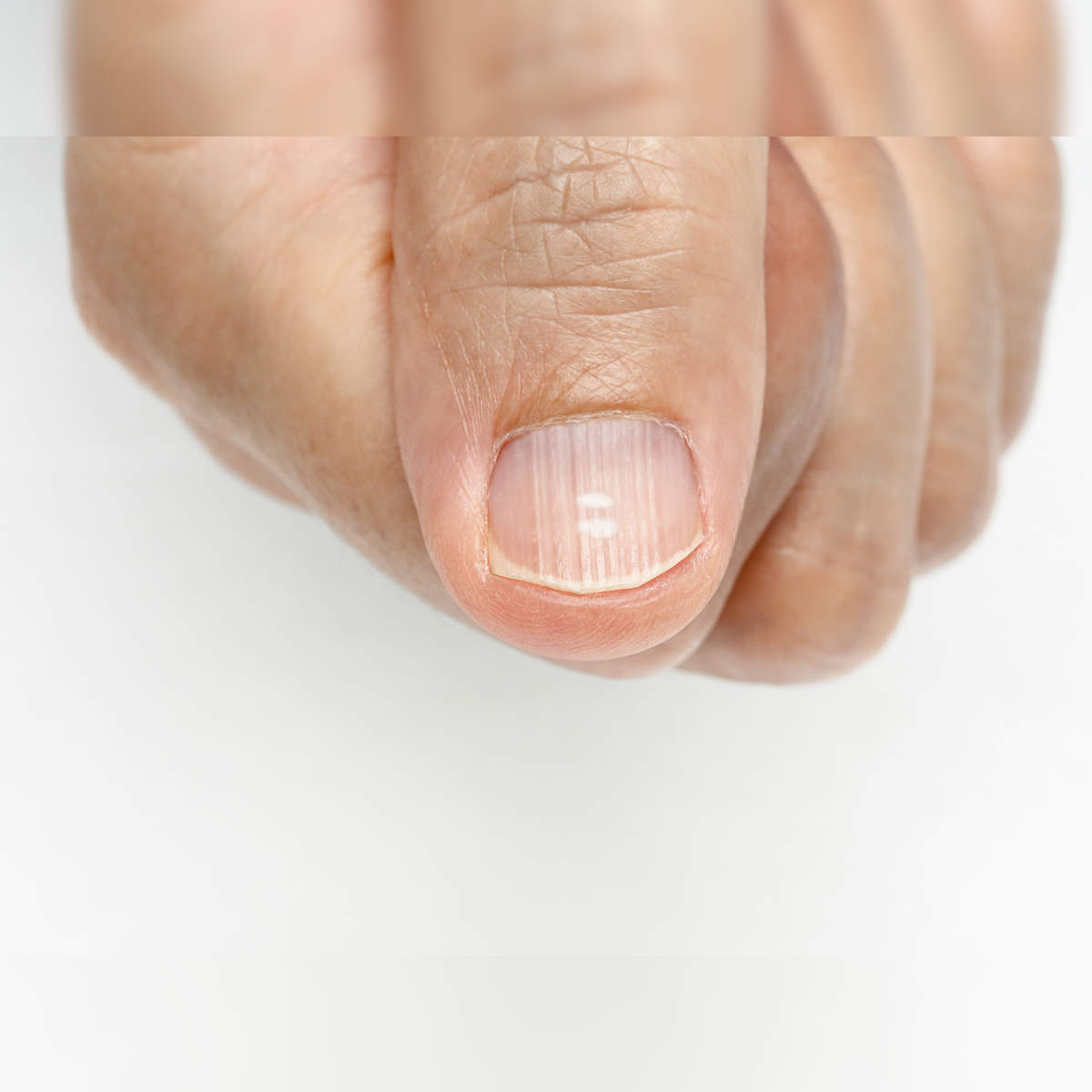 Lines on Nails: Here is What They Indicate - HealthKart