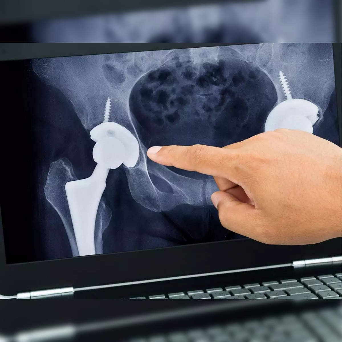 hip surgery: A new lease of life after a complex hip surgery - The Economic  Times