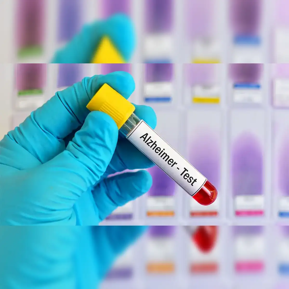 Alzheimer's blood tests: Blood tests for Alzheimer's may be coming to your doctor's office. Here's what to know - The Economic Times