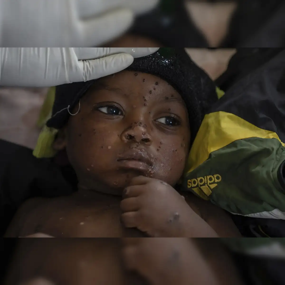 Mpox Cases: Worries increase as new strain discovered that spreads 