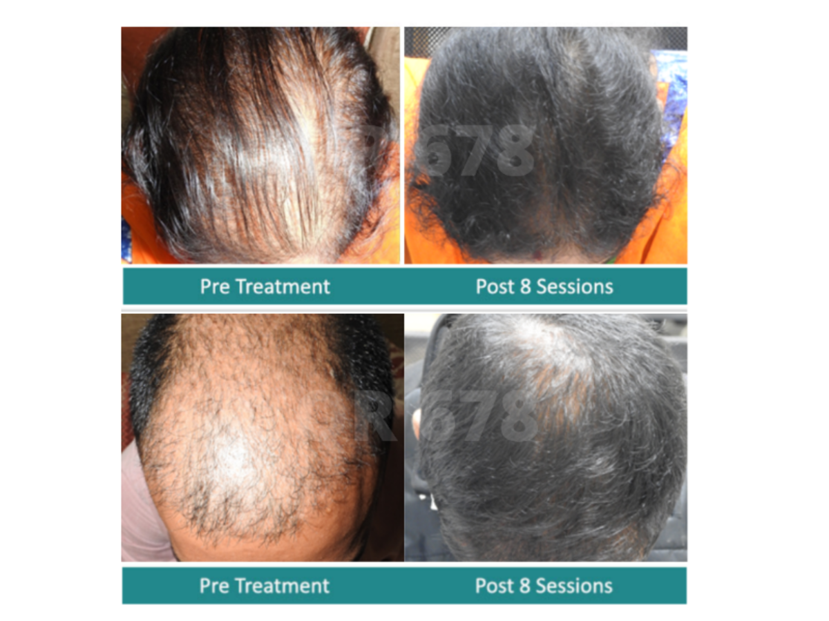 What are the latest hair loss treatments available in the market Punjab