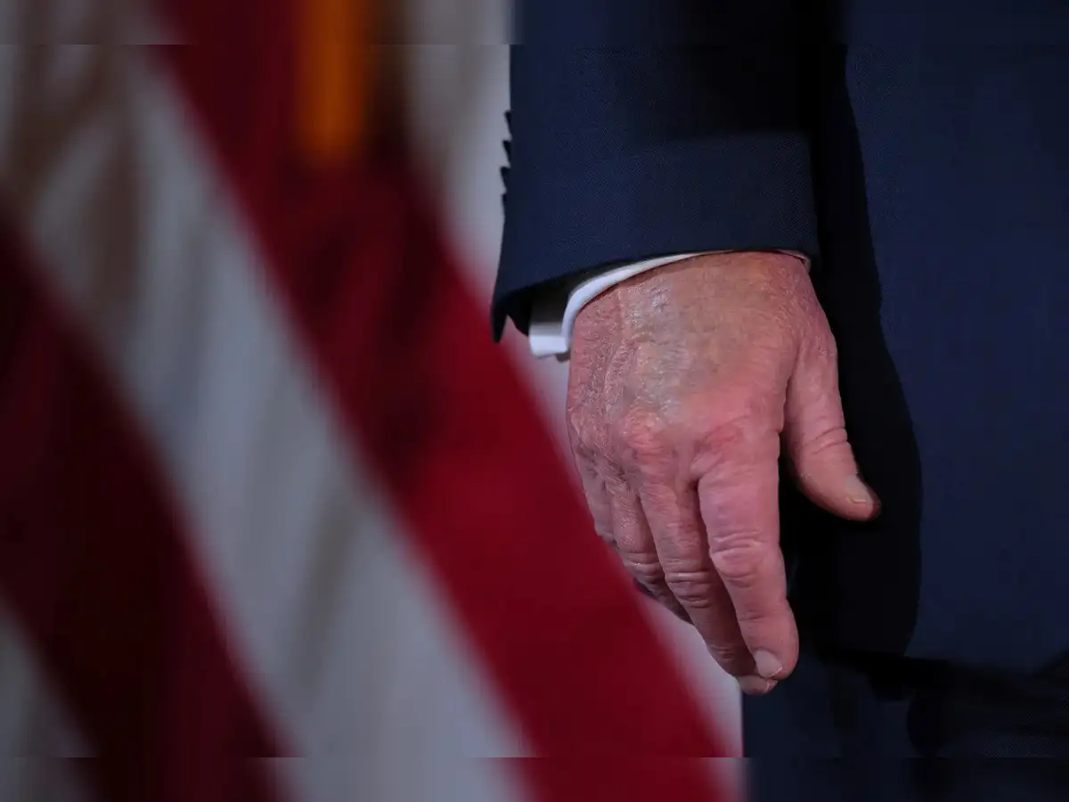 How serious is Trump's chronic venous insufficiency, and could it signal  something more dangerous like heart failure? - The Economic Times