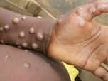 Monkeypox: WHO calls for emergency meeting